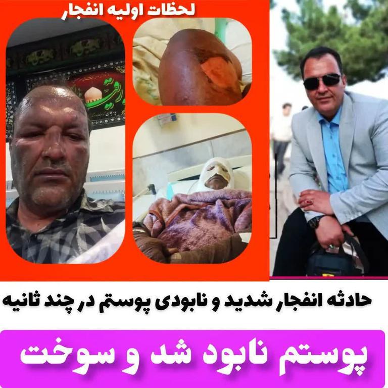 درمان سوختگی