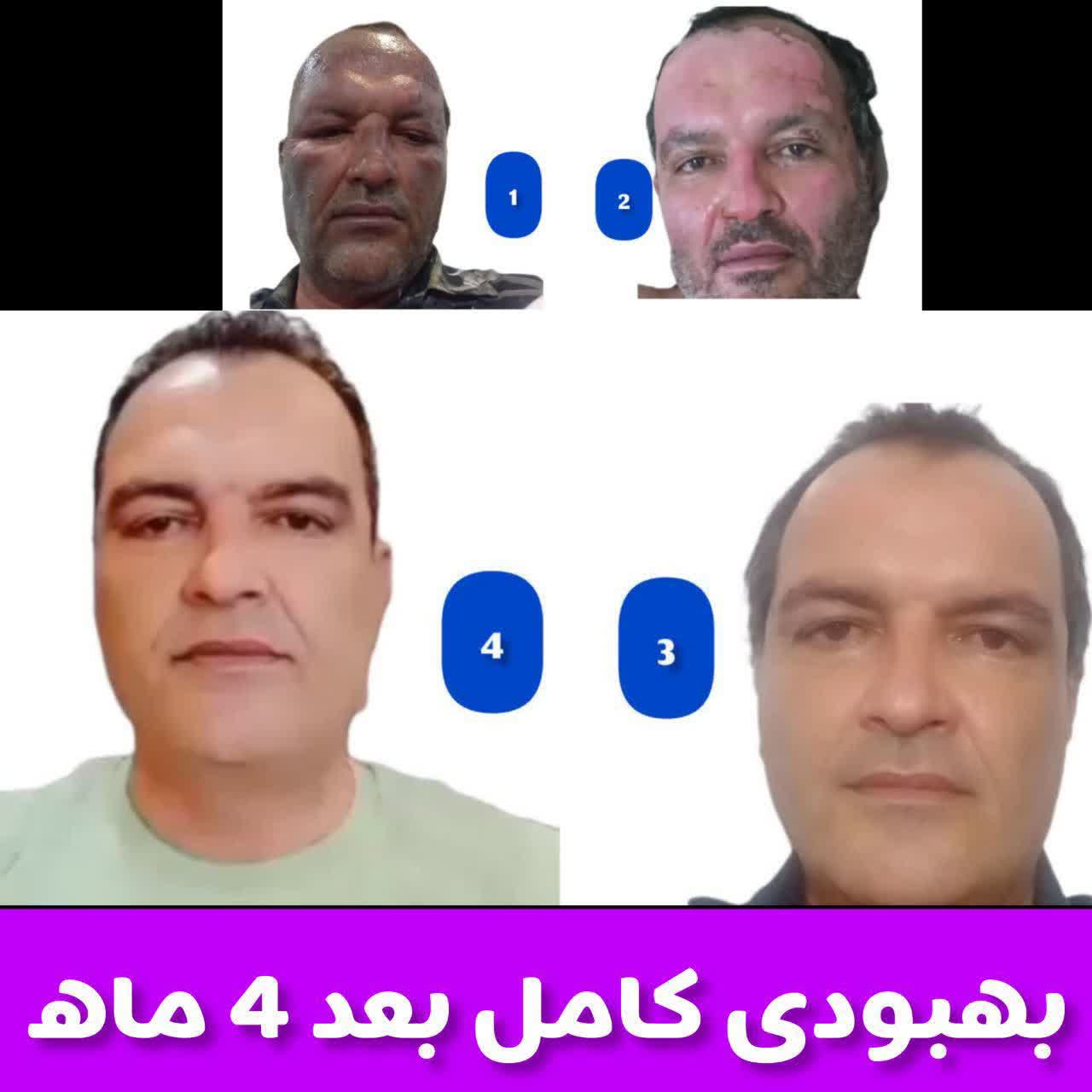 روند بهبودی پوستم